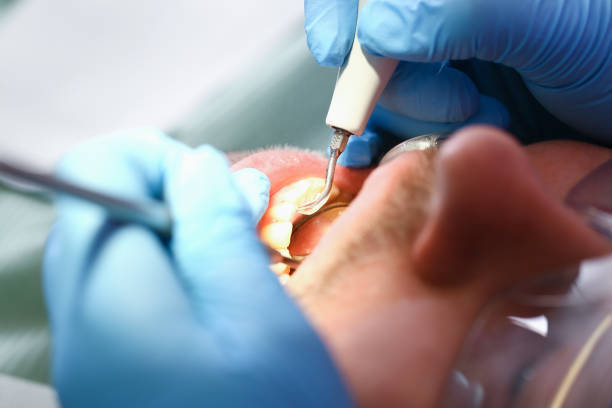 Best Emergency Dentist for Lost Fillings or Crowns in New Haven, MI