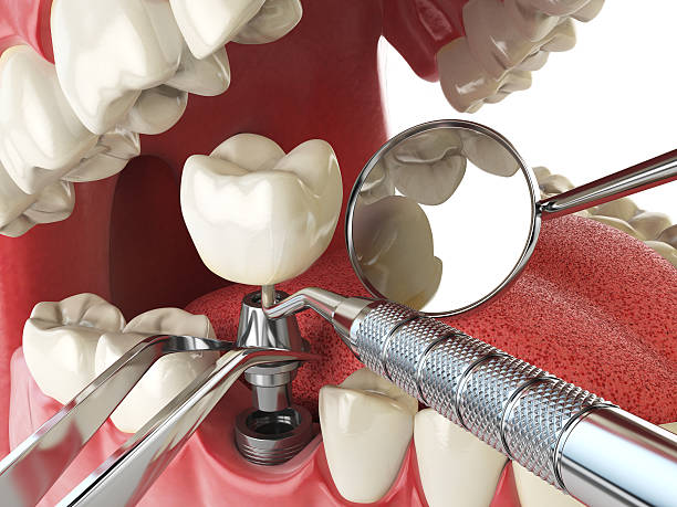 Best Emergency Dental Extractions in New Haven, MI